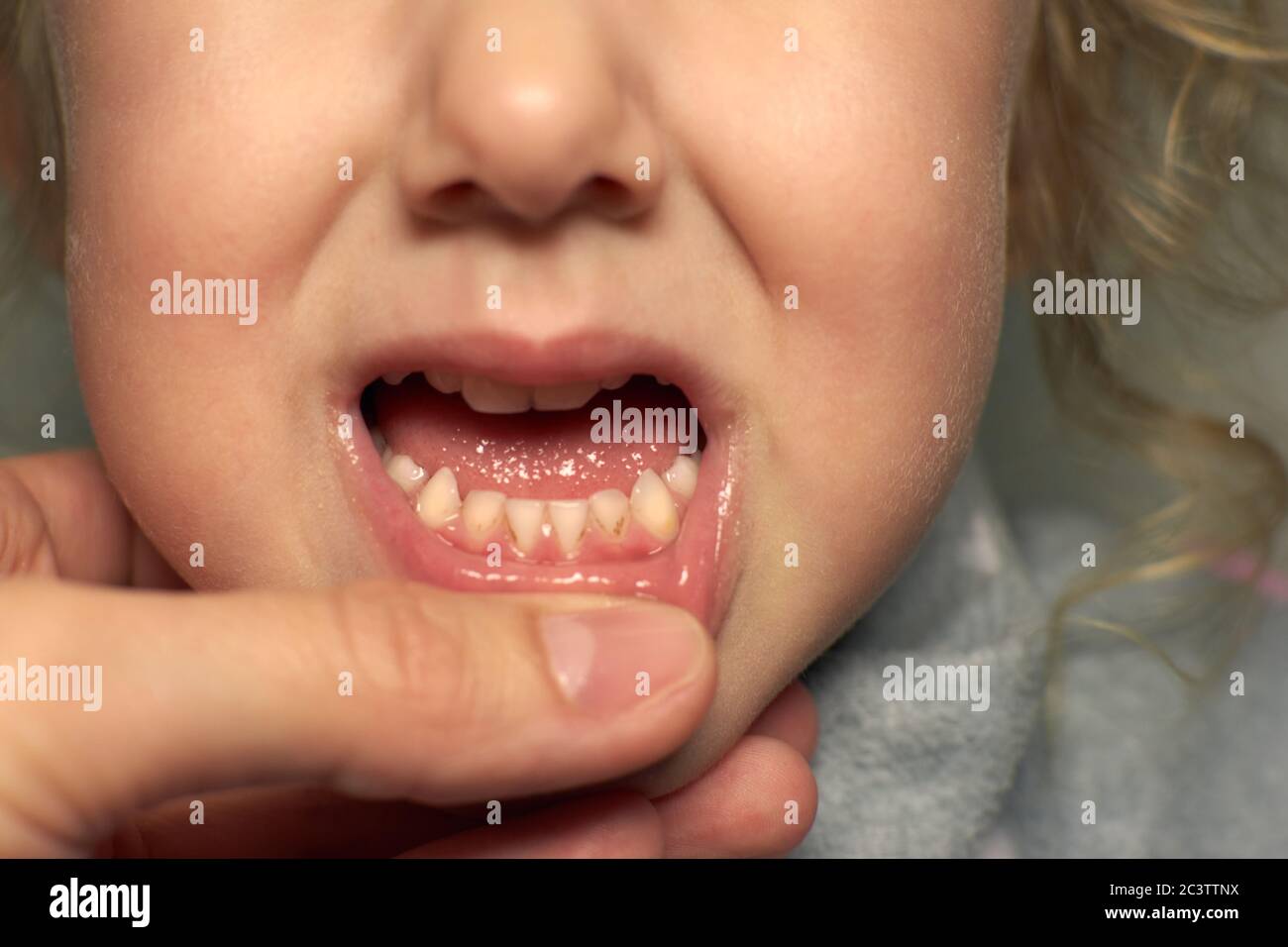 Gros plan des dents malsaines de bébé. Fille bouche ouverte montrant carie dents pourriture, mauvaises dents. Banque D'Images