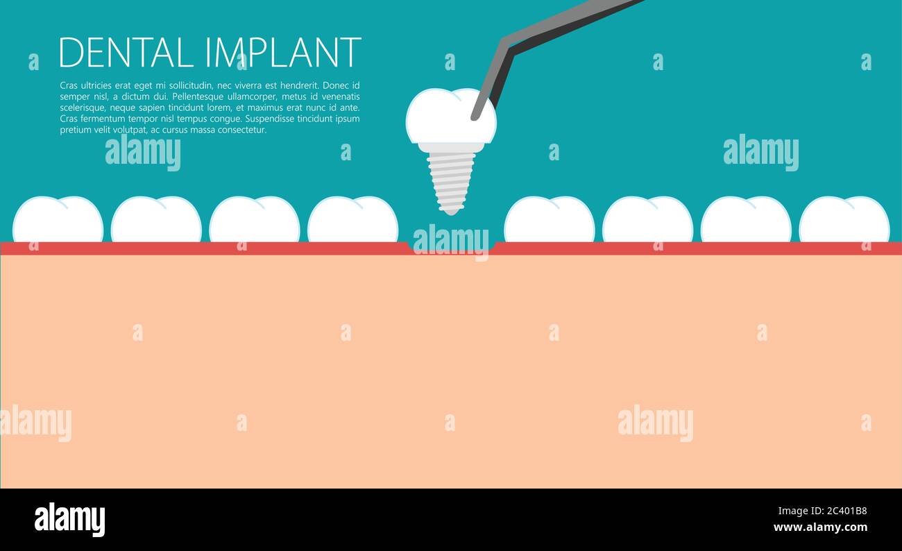 Vecteur plat d'implant dentaire Illustration de Vecteur