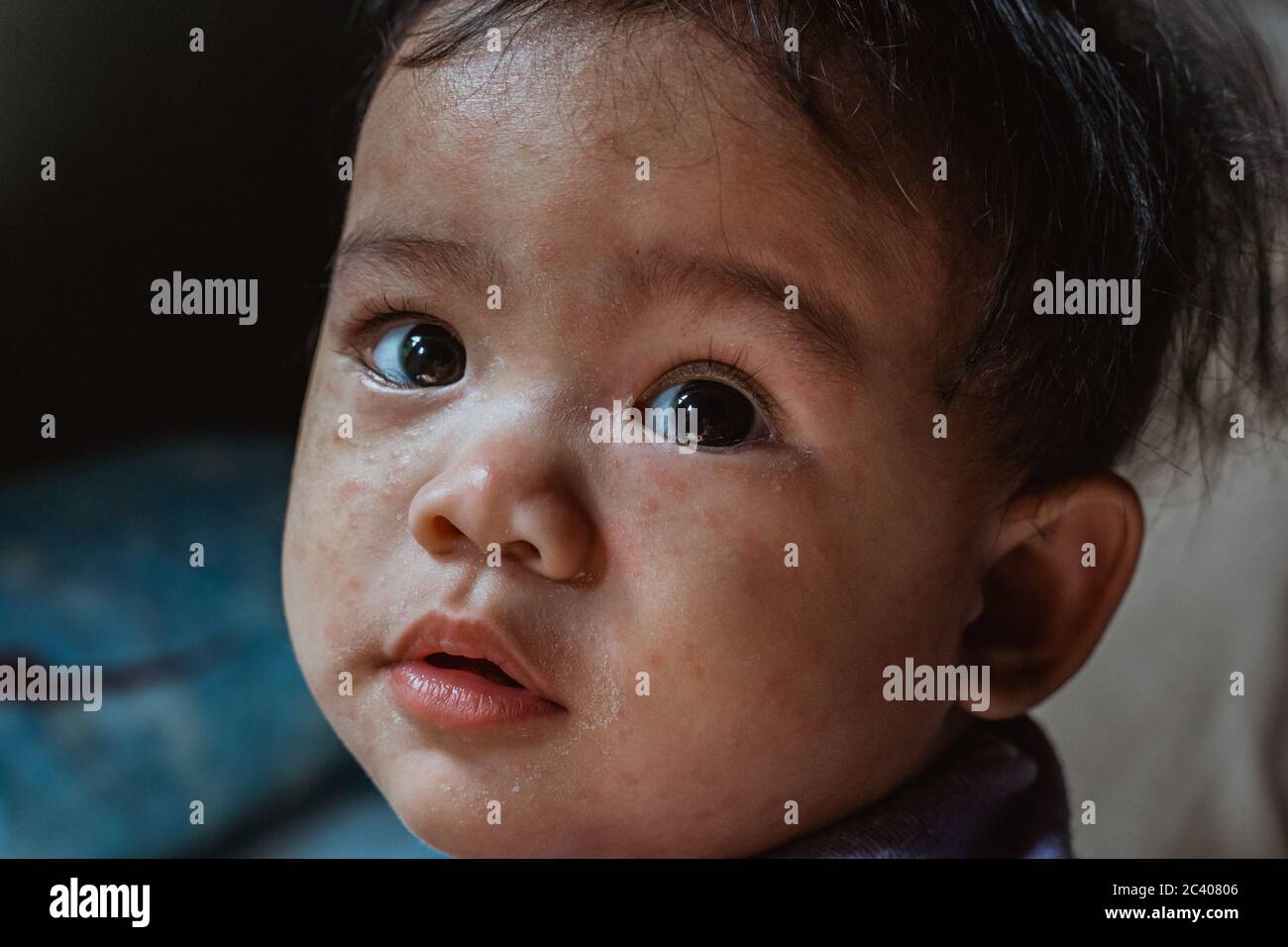 portrait d'un bébé asiatique avec des éruptions cutanées dues à des allergies ou à des irritations et démangeaisons Banque D'Images