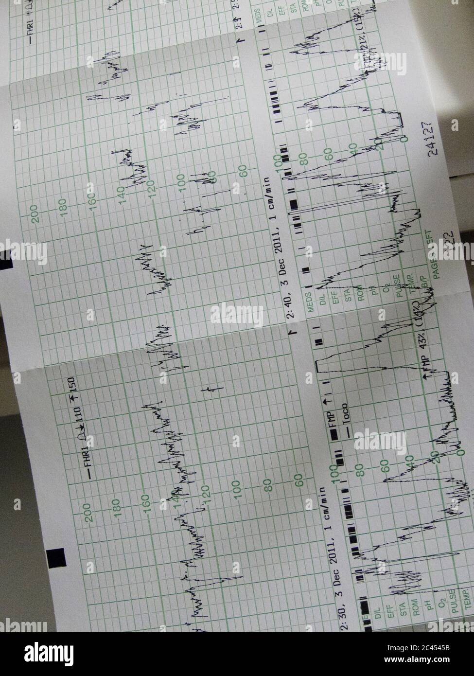 Cardiotocography Banque D'Images