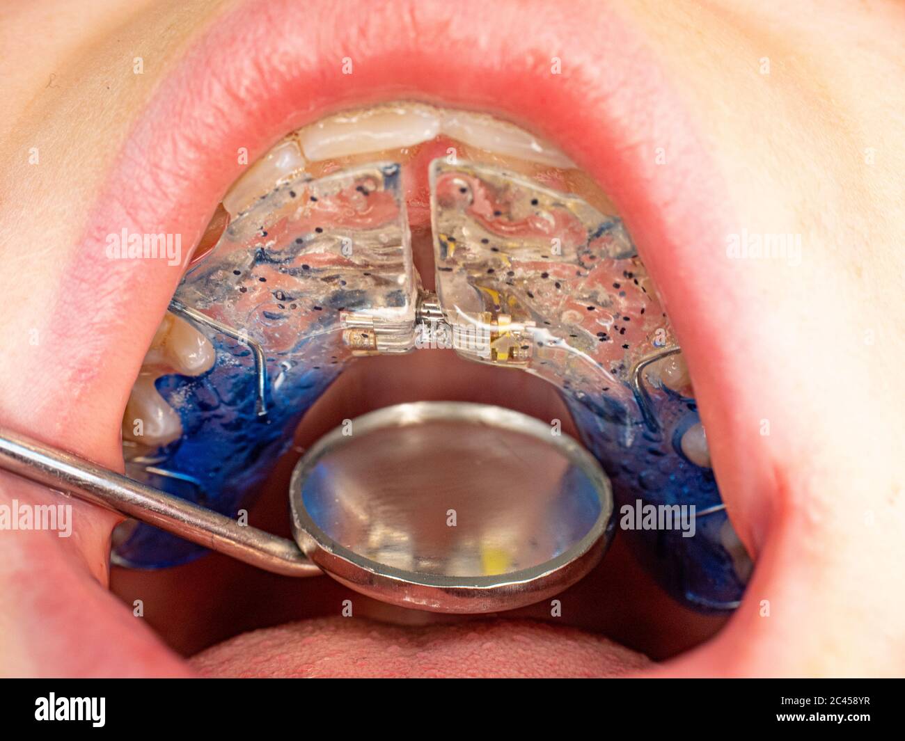 Photo de dents avec des renforts orthodontiques. Le port d'accolades est une solution très populaire pour la correction des malformations congénitales des mâchoires Banque D'Images