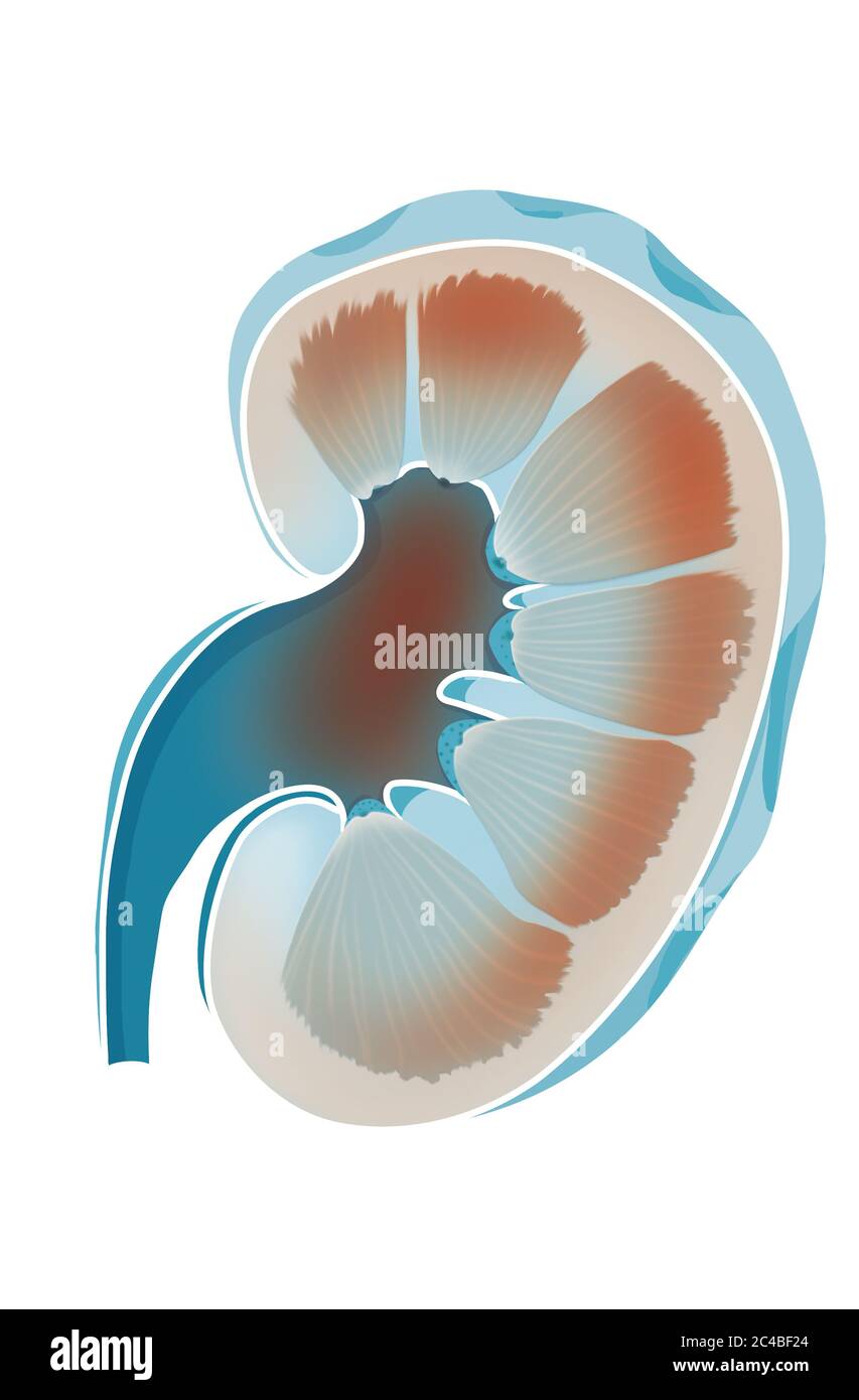 Pyélonéphrite, après infection urinaire, cystite. La pyélonéphrite est une infection d'origine bactérienne. Elle est causée par un traitement non traité ou un traitement mal t Banque D'Images