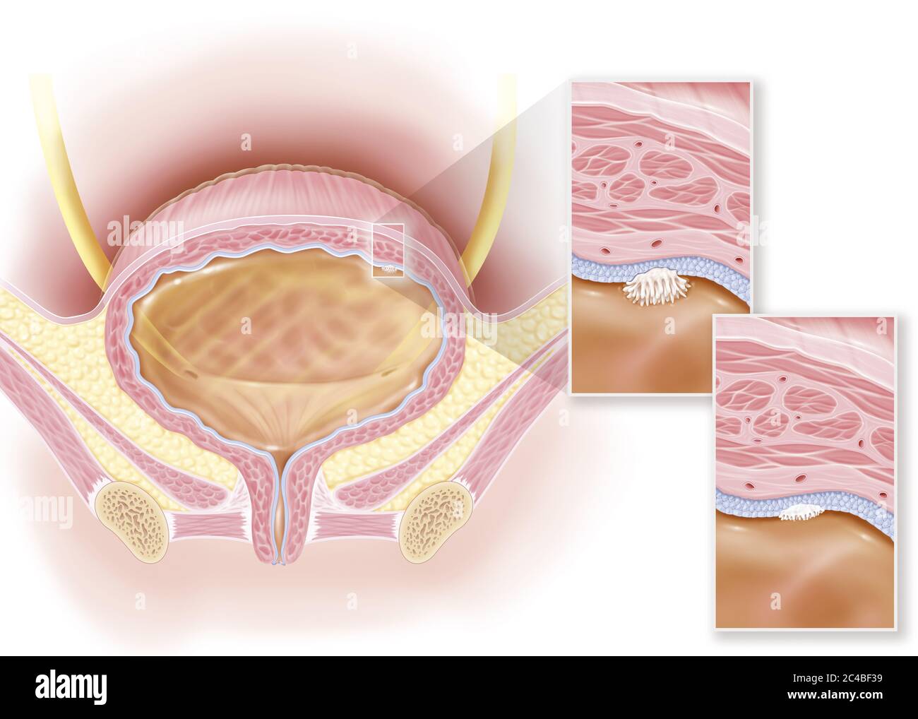 Stade 0a et 0is cancer superficiel de la vessie, carcinome urothélial et in situ. Cette illustration montre la vessie d'une femme avec, dans le coin supérieur droit de t Banque D'Images