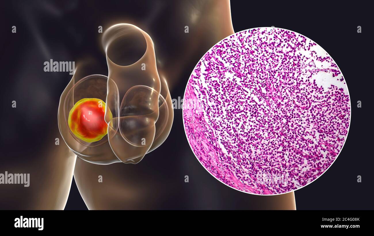 Cancer testiculaire, séminome spermastocytique malin, illustration informatique et micrographe léger. Un séminome est une tumeur maligne (cancer) du testicule. Bien qu'il s'agisse d'un cancer rare, il s'agit du cancer le plus fréquent chez les hommes de 15 à 35 ans. Il provient de cellules germinales anormales (précurseurs des spermatozoïdes) dans les tubules séminifères. L'ablation chirurgicale des testicules affectés (orchidectomie) est suivie d'une radiothérapie et d'une chimiothérapie si nécessaire. Banque D'Images