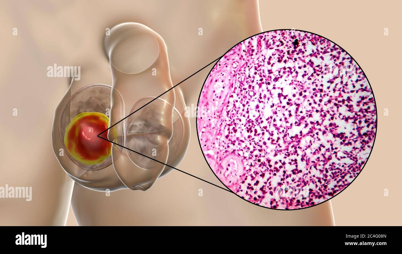 Cancer testiculaire, séminome spermastocytique malin, illustration informatique et micrographe léger. Un séminome est une tumeur maligne (cancer) du testicule. Bien qu'il s'agisse d'un cancer rare, il s'agit du cancer le plus fréquent chez les hommes de 15 à 35 ans. Il provient de cellules germinales anormales (précurseurs des spermatozoïdes) dans les tubules séminifères. L'ablation chirurgicale des testicules affectés (orchidectomie) est suivie d'une radiothérapie et d'une chimiothérapie si nécessaire. Banque D'Images