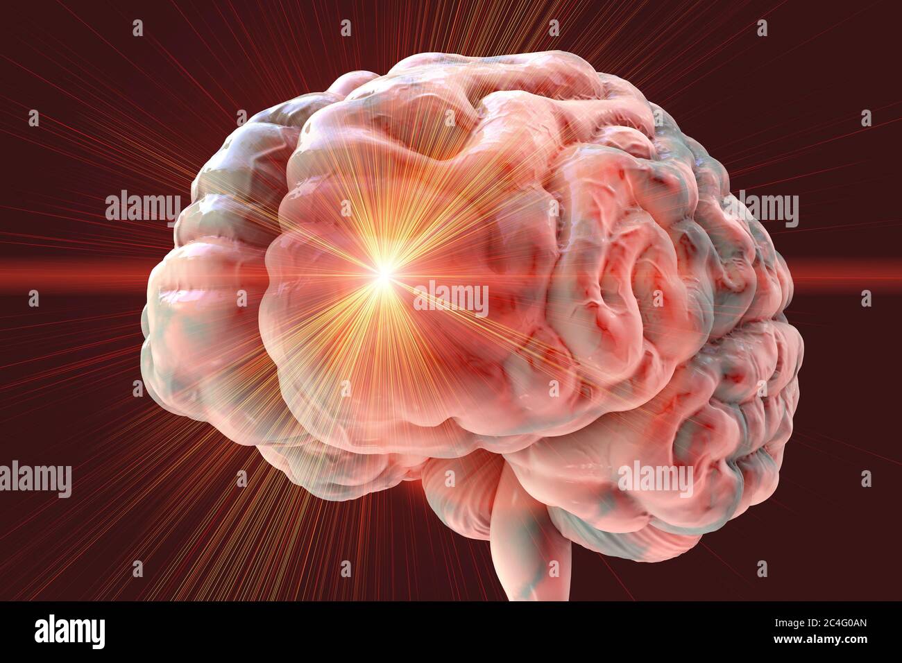 Les accidents vasculaires cérébraux, l'illustration de l'ordinateur. Banque D'Images