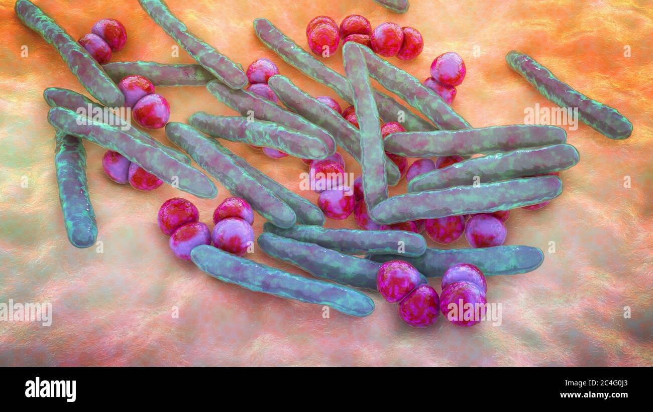 Illustration informatique de la co-infection avec deux bactéries pathogènes respiratoires majeures, Mycobacterium tuberculosis (en forme de tige) et Streptococcus pneumonia (sphérique). Les infections pulmonaires mixtes avec deux agents pathogènes ou plus sont courantes chez les patients immunodéprimés, en particulier chez les personnes infectées par le VIH. Banque D'Images