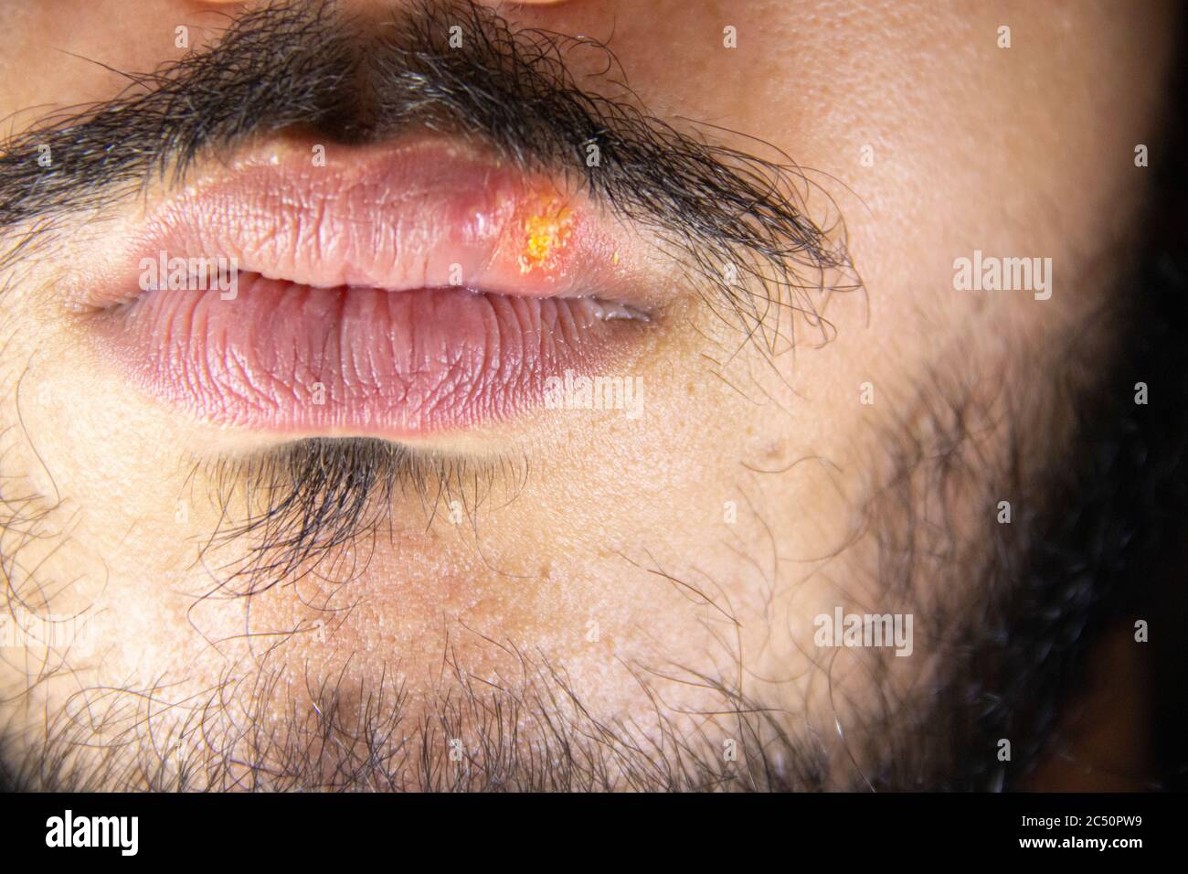Herpes mouth Banque de photographies et d’images à haute résolution Alamy