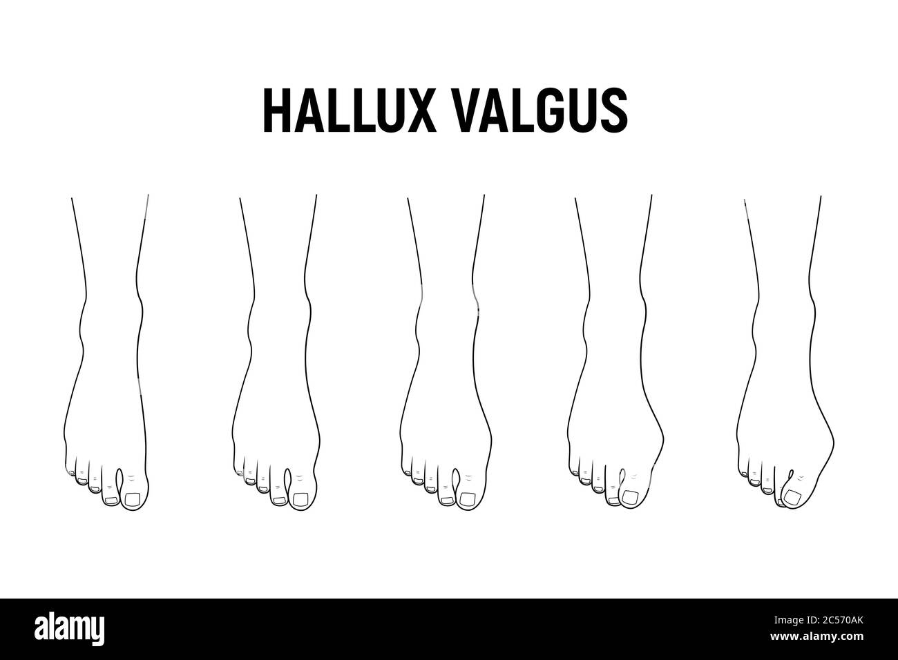 Stade De La Maladie De Hallux Valgus Illustration Vectorielle Stade De La Maladie De Hallux Valgus Illustration Vectorielle