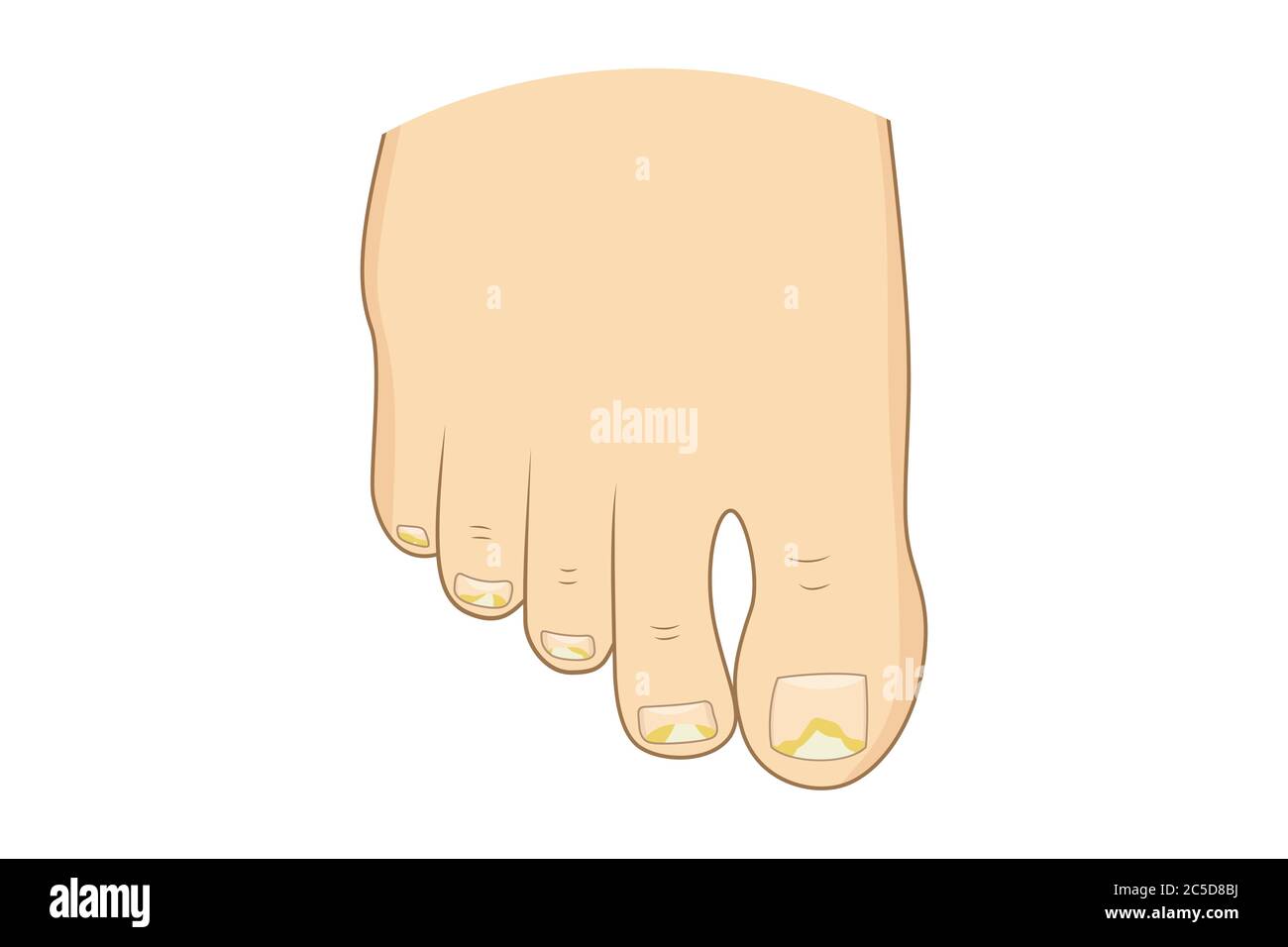 Illustration du vecteur de mycose de l'ongle du pied. Ongles d'orteil santé,  sentir champignon, soins du corps Image Vectorielle Stock - Alamy