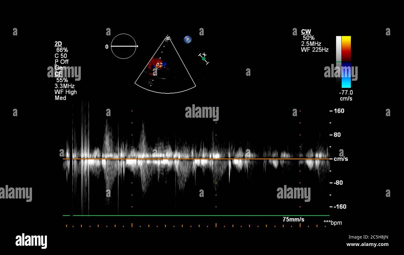 Image du cœur pendant l'échographie transœsophagienne avec mode Doppler. Banque D'Images