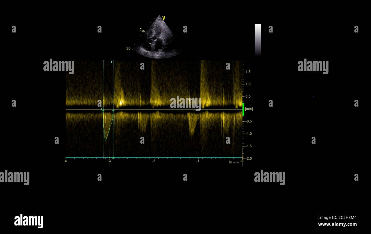 Image du cœur en mode échelle de gris pendant l'échographie transœsophagienne. Banque D'Images