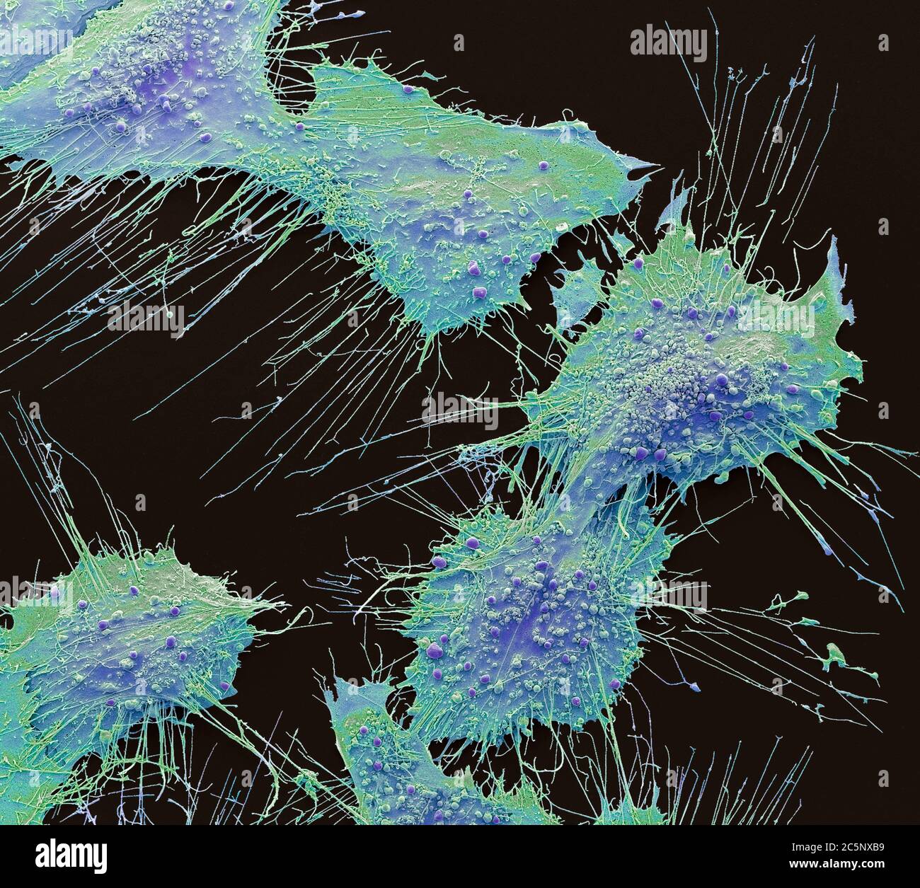 Cellules cancéreuses osseuses. Micrographe électronique à balayage coloré des cellules cancéreuses de l'ostéosarcome. L'ostéosarcome est un néoplasme malin agressif qui provient de cellules mésenchymateuses transformées primitives. C'est la forme histologique la plus commune du cancer primaire des os. La plupart des personnes diagnostiquées avec un ostéosarcome ont moins de 25 ans et on pense qu'il se produit plus souvent chez les hommes que chez les femmes. L'ostéosarcome est souvent traité par une combinaison de thérapies qui peuvent inclure la chirurgie, la chimiothérapie et la radiothérapie. Agrandissement : x1000 lorsqu'il est imprimé à 10 centimètres de large. Banque D'Images