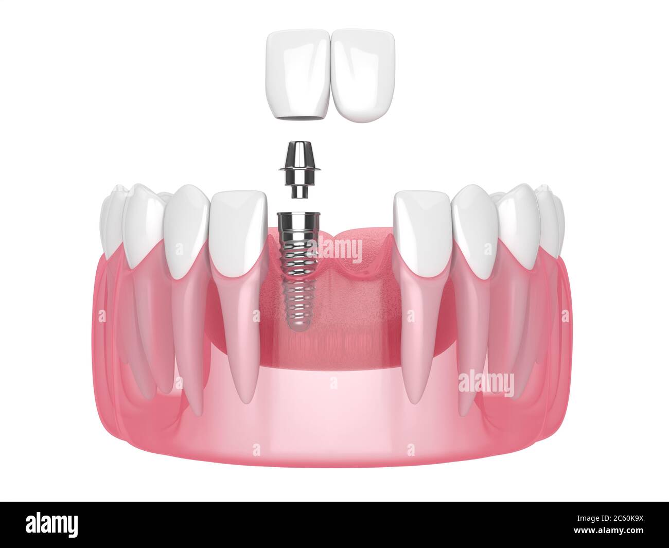 rendu 3d de la mâchoire avec pont en porte-à-faux incisive dentaire supporté par l'implant Banque D'Images