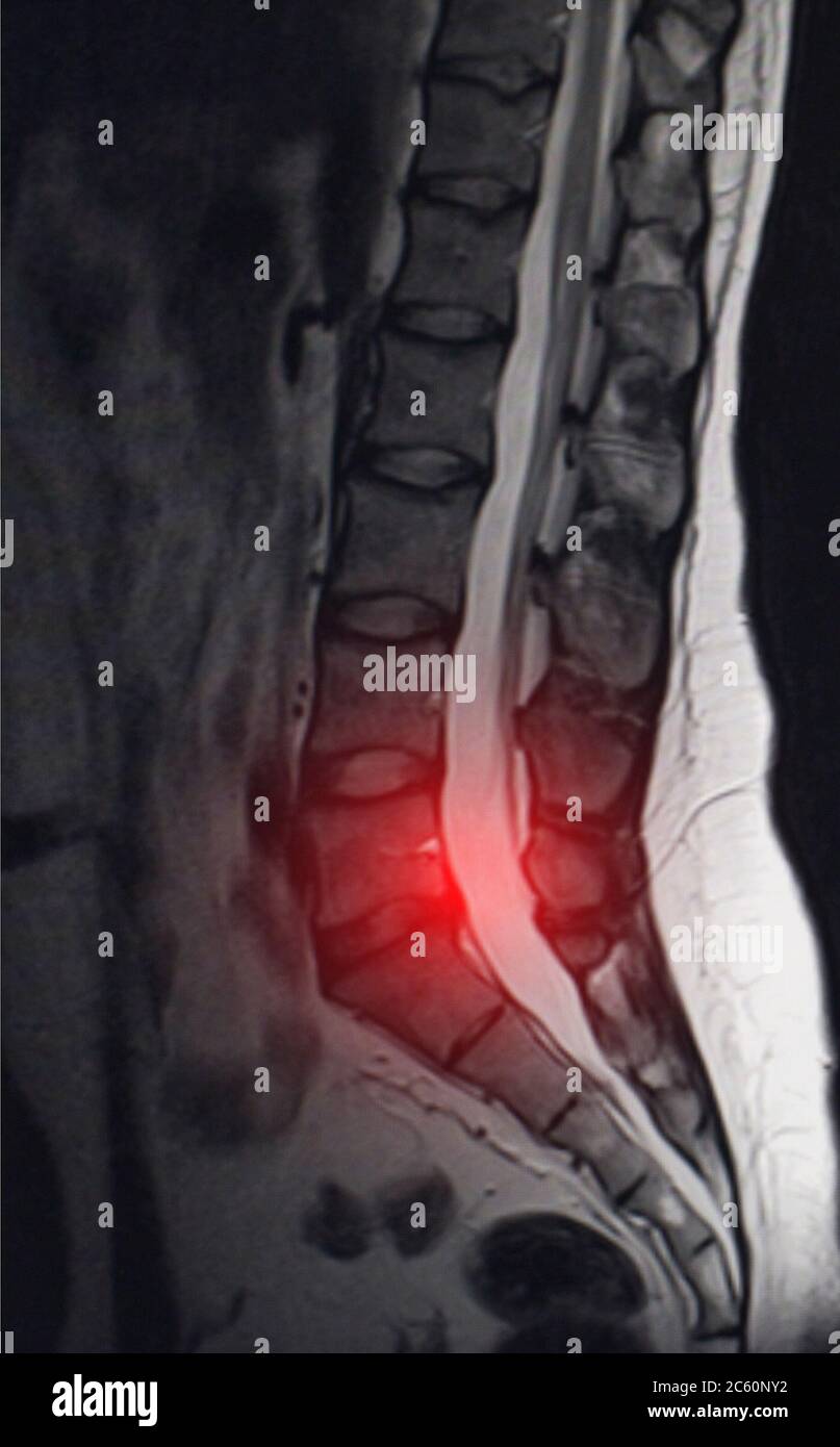 Image après examen de l'imagerie par résonance magnétique. Concept d'examen du rachis, otséochondrose, hernie intervertébrale lombaire Banque D'Images