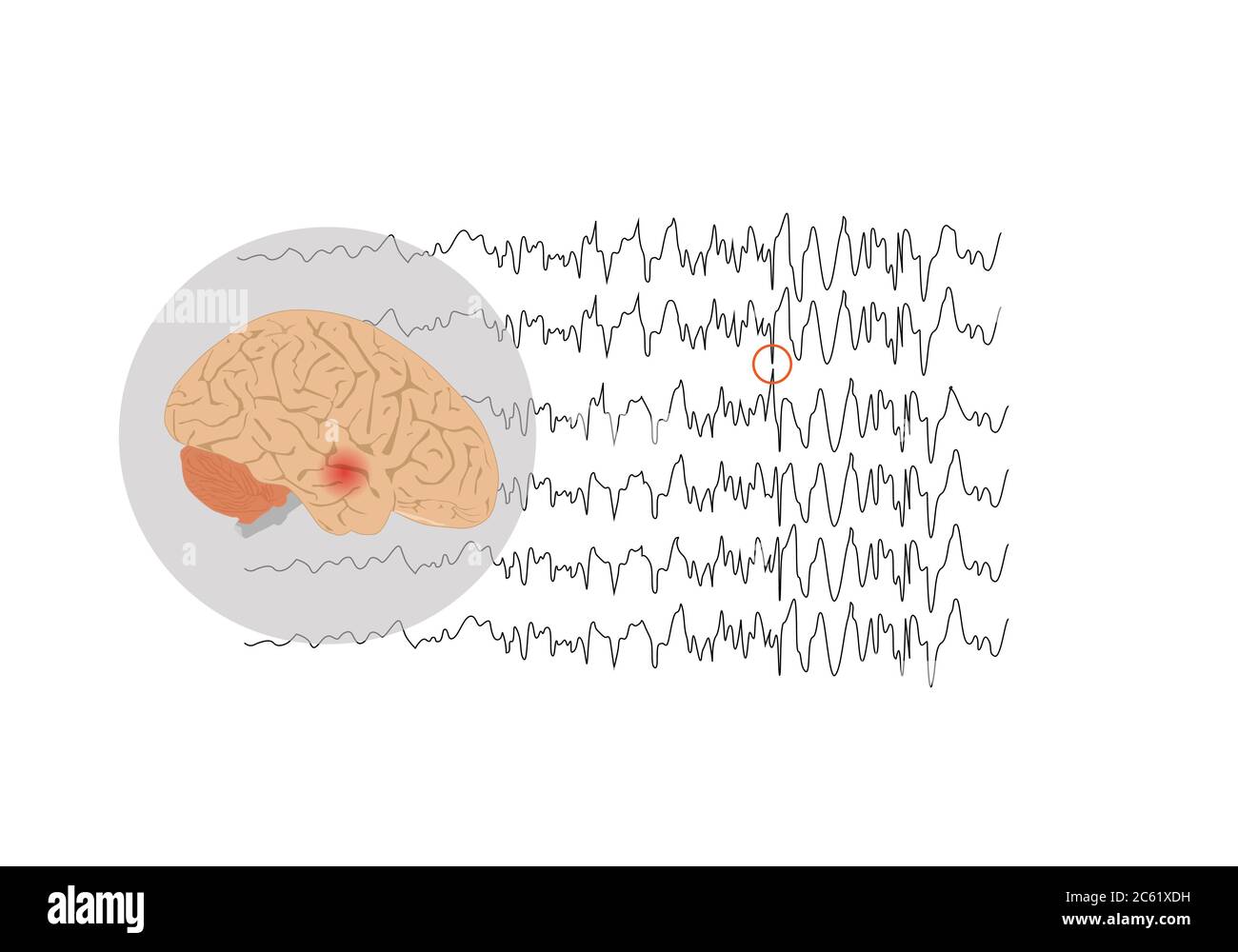 Illustration vectorielle du cerveau humain et des ondes cérébrales anormales représentant une crise focale dans le lobe temporal Illustration de Vecteur