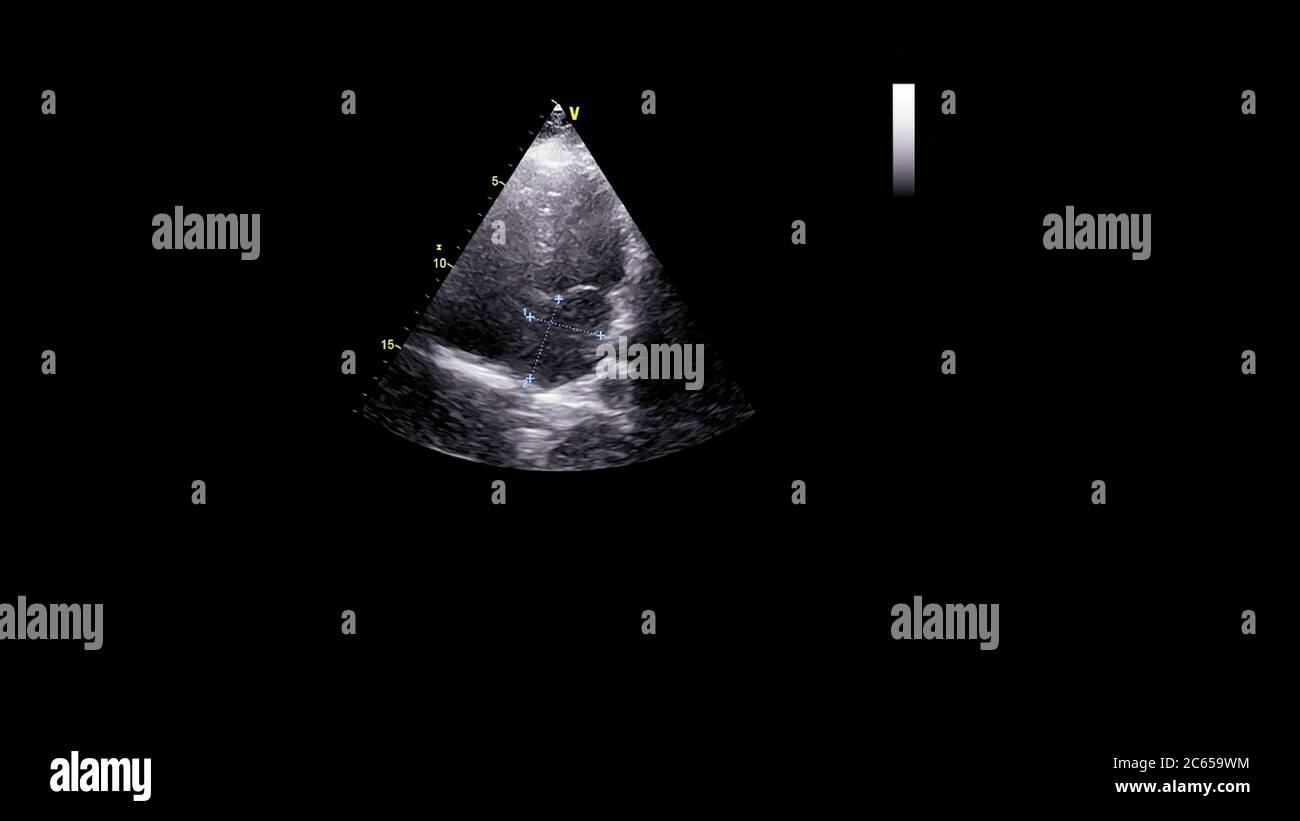 Image du cœur en mode échelle de gris pendant l'échographie transœsophagienne. Banque D'Images