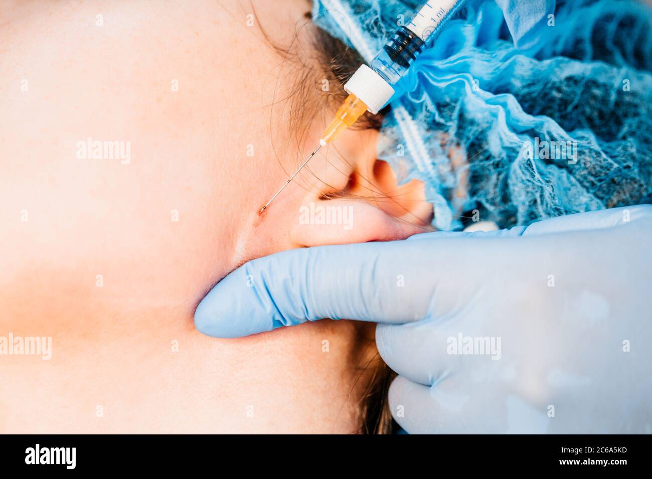 Mandibloplastie non chirurgicale - les coins de la mandibule - indolore et sûr injections intradermiques sont efficaces pour corriger le mimic et le wri sénile Banque D'Images