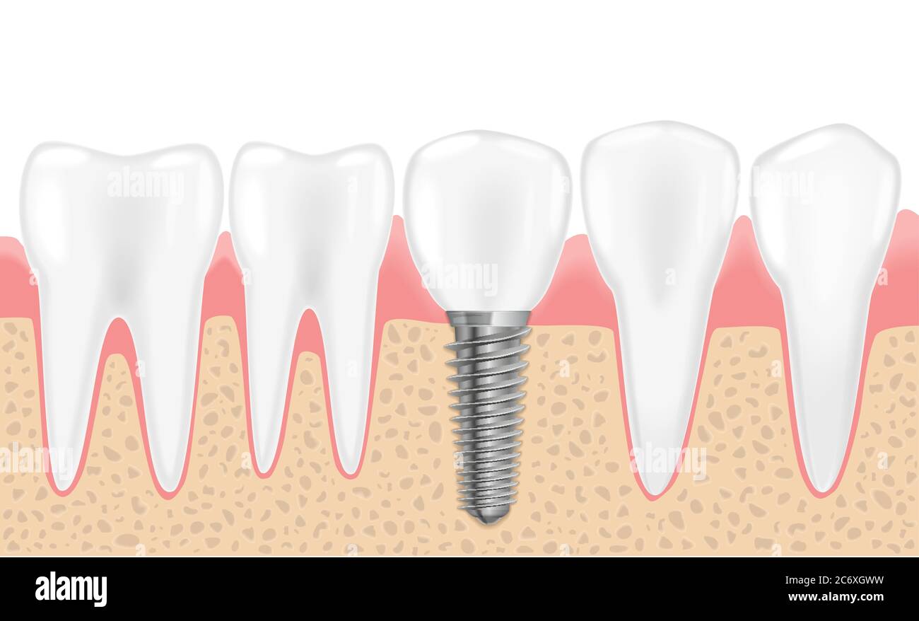 Des dents et un implant dentaire sains. Illustration vectorielle réaliste de la dentisterie médicale dentaire. Implantation dentaire des dents humaines Illustration de Vecteur