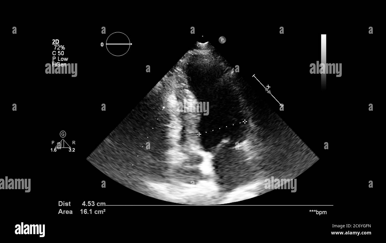 Image du cœur en mode échelle de gris pendant l'échographie transœsophagienne. Banque D'Images