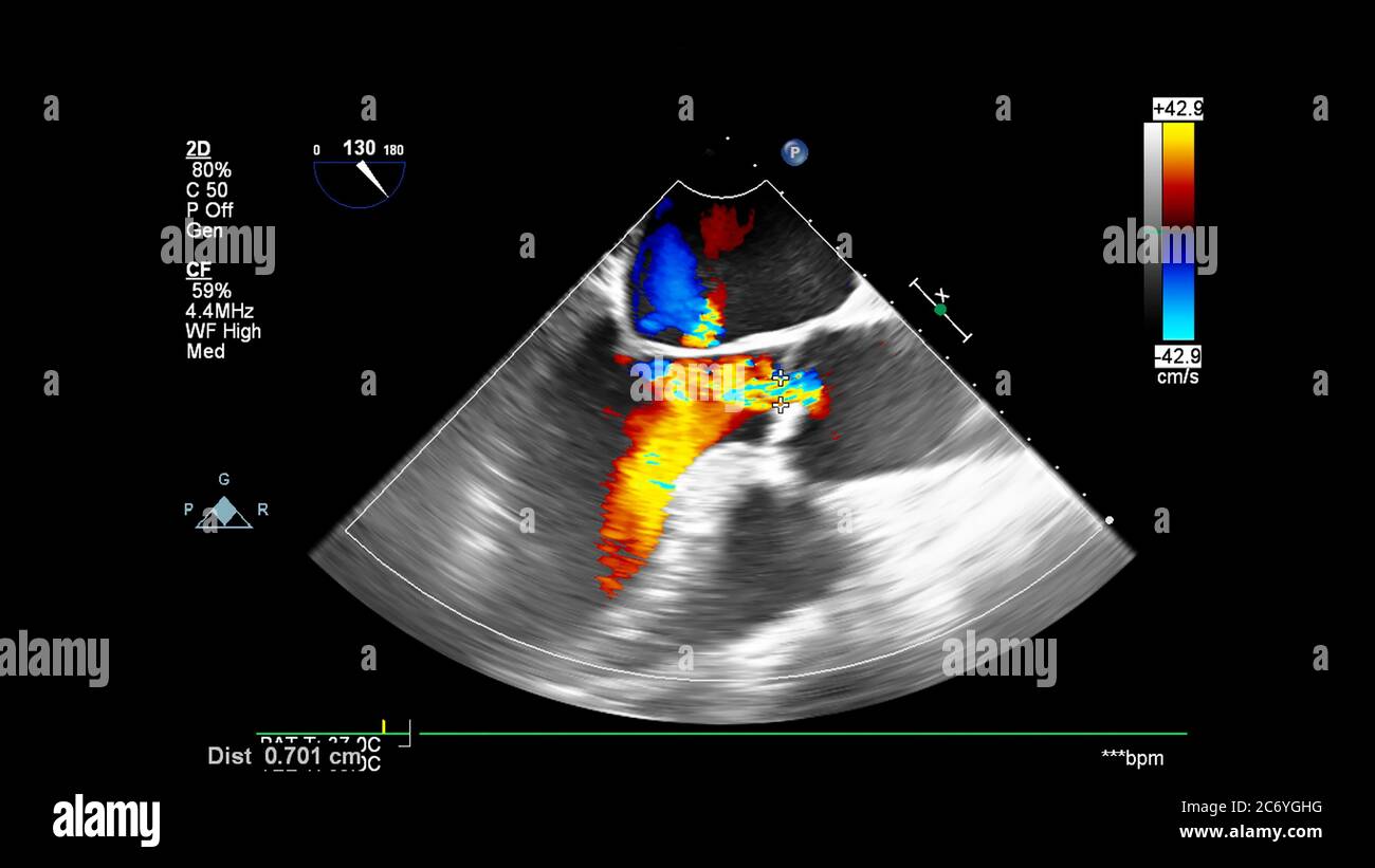 Image du cœur pendant l'échographie transœsophagienne avec mode Doppler. Banque D'Images