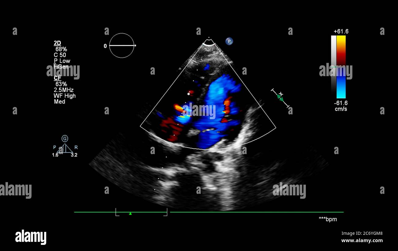Image du cœur pendant l'échographie transœsophagienne avec mode Doppler. Banque D'Images