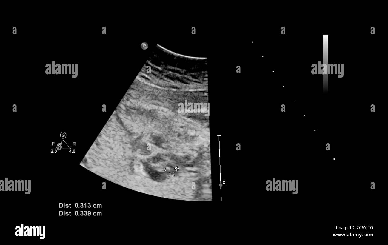 Ecran d'échographie avec échocardiographie fœtale. Banque D'Images