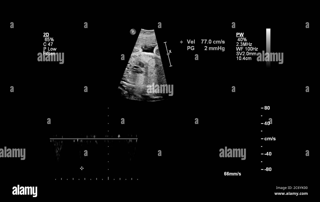 Ecran d'échographie avec échocardiographie fœtale. Banque D'Images