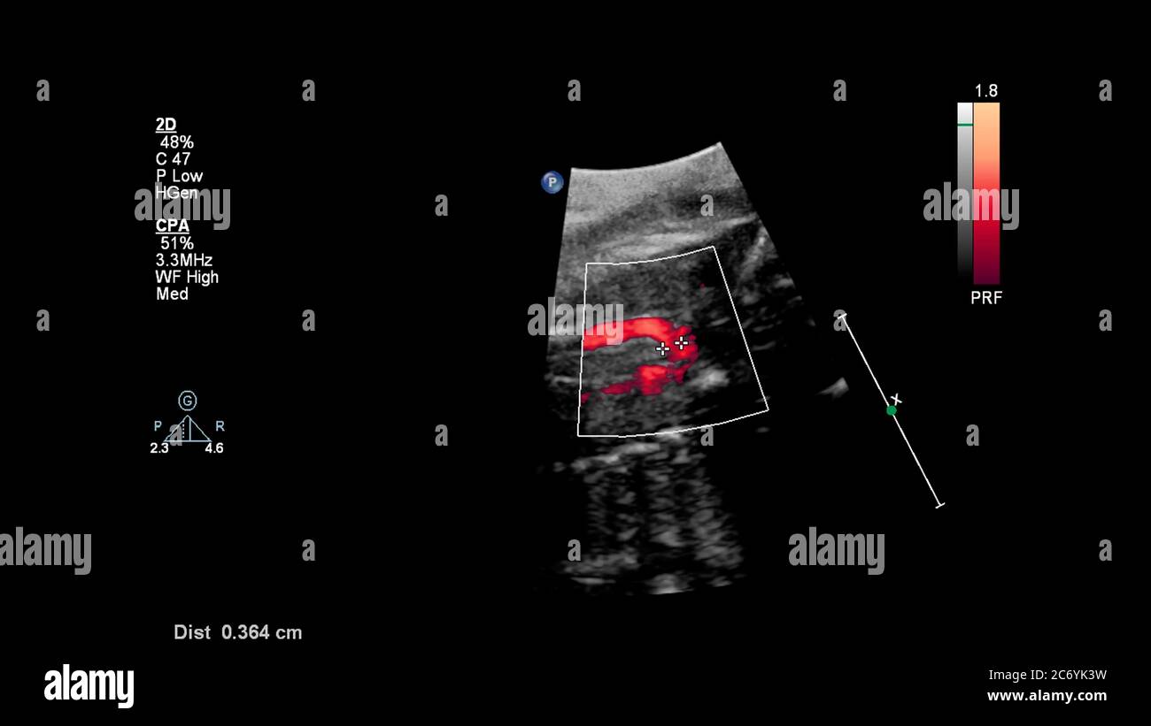 Ecran d'échographie avec échocardiographie fœtale. Banque D'Images