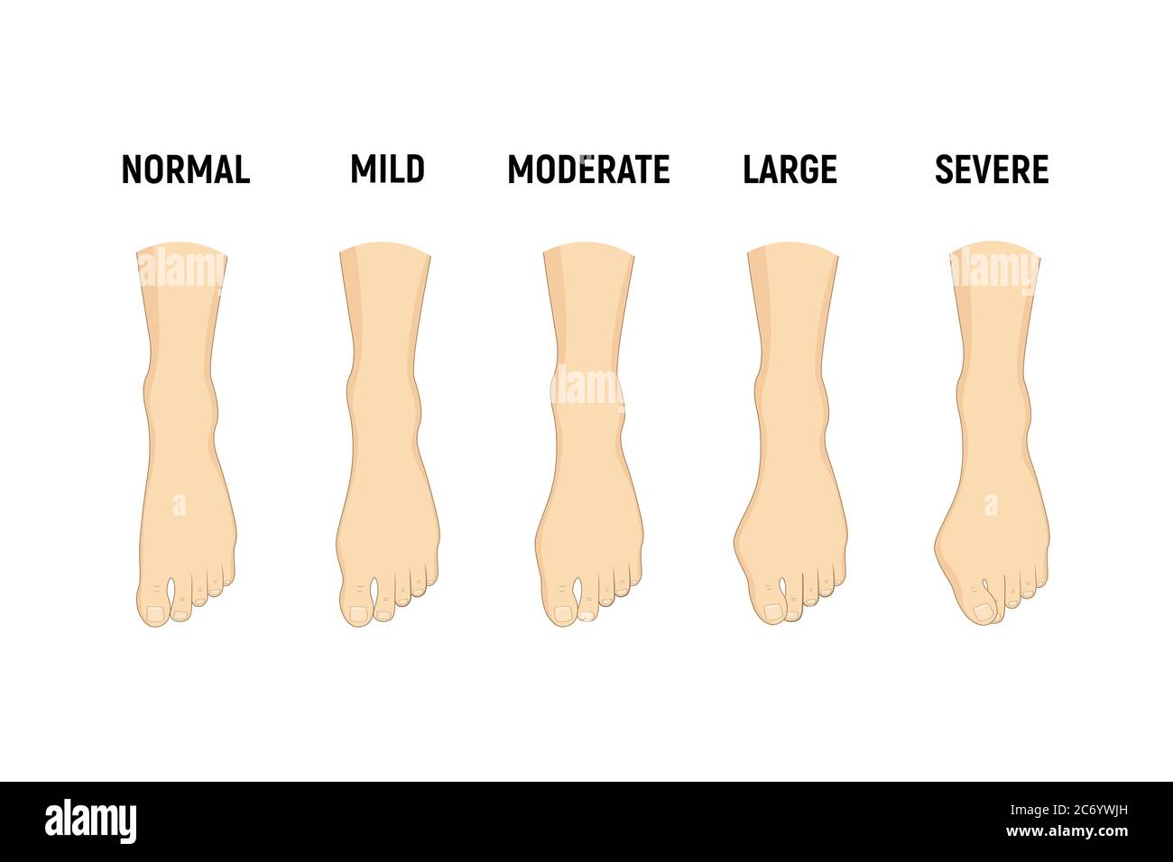Stade De La Maladie De L hallux Valgus Normal L ger Mod r Grand Stade De La Maladie De L hallux Valgus Normal L ger Mod r Grand