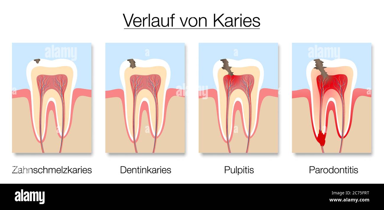 Infographie sur les stades de la carie, étiquetage allemand, développement de la carie dentaire avec émail et dentine, pulpite et parodontite. Banque D'Images