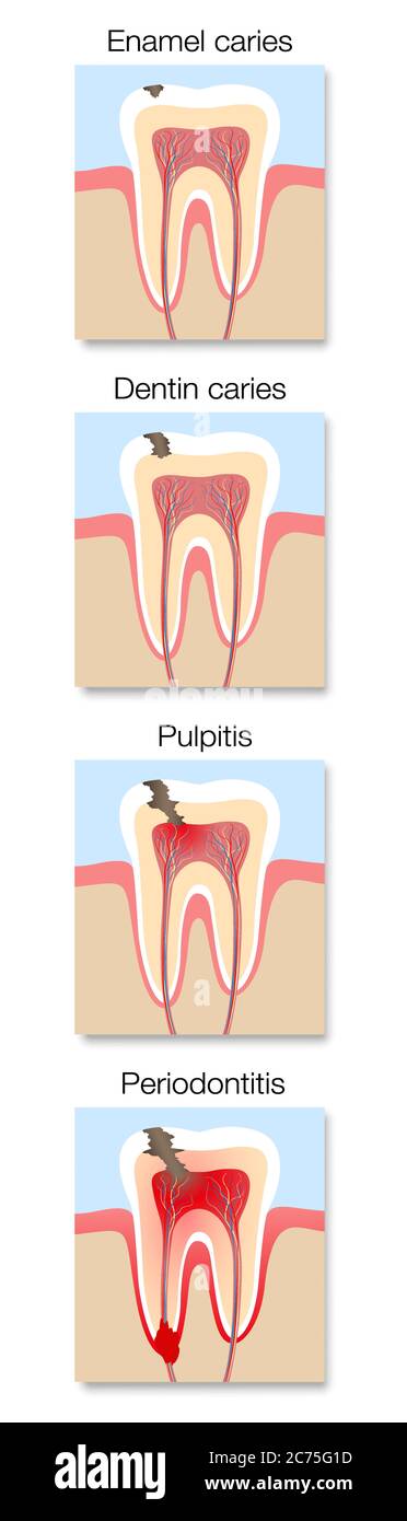 Infographie sur le développement des caries, stades avec une section transversale de caries dentaires avec émail et dentine, pulpite et parodontite. Banque D'Images
