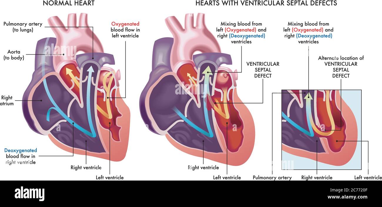 Illustration médicale qui compare un coeur normal avec des coeurs affligés par des défauts septaux ventriculaires, une ouverture anormale (trou) dans le coeur, avec un Illustration de Vecteur