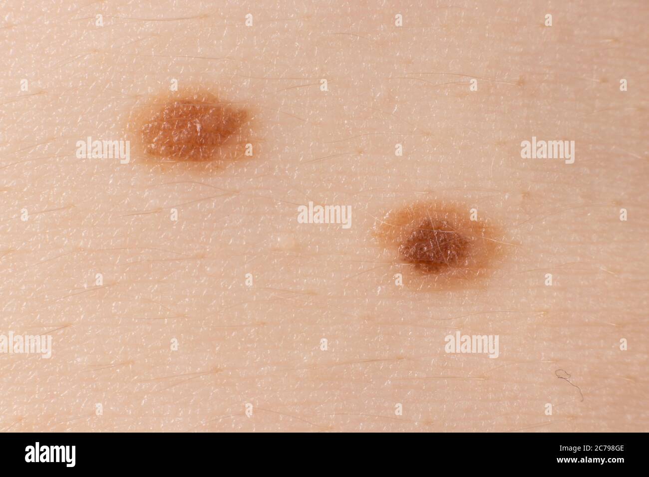 Deux photos macro de marque de naissance de Mole nevus sur la peau humaine. Gros plan. Banque D'Images