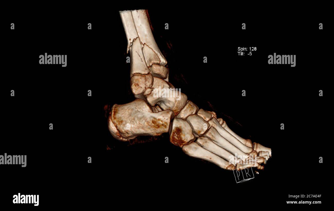 Image de rendu volumique de tomographie (CT VR) de fracture des os de jambe (Tibia et péroné) au-dessus de la cheville, rendu 3D Banque D'Images
