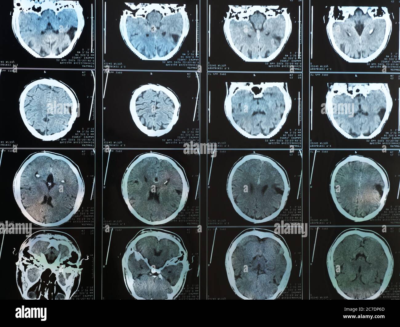 IRM du cerveau humain après un traumatisme crânien. Photo de haute qualité Banque D'Images