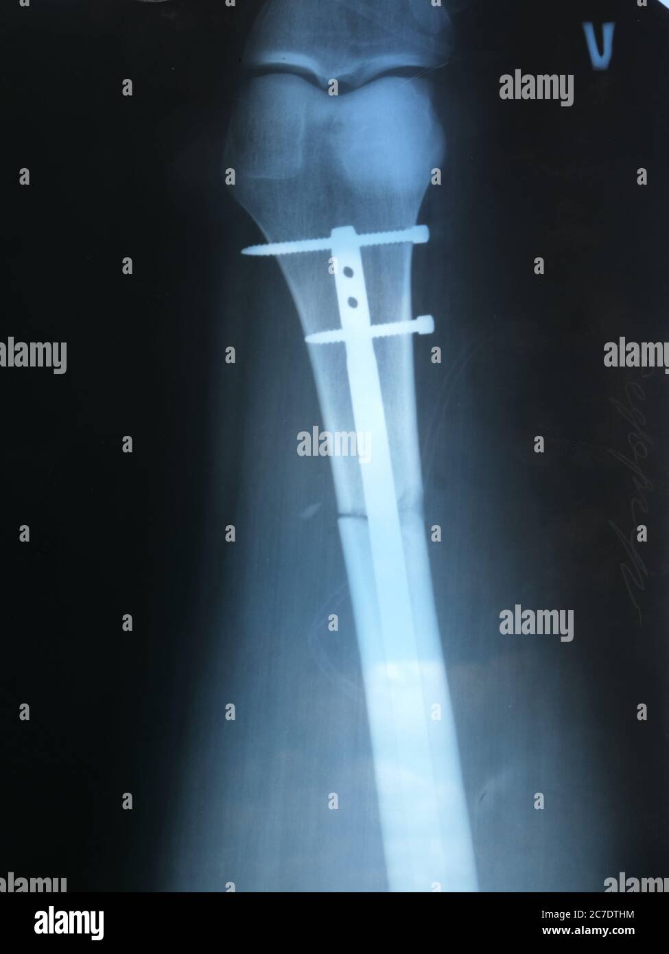 Cette photo montre la radiographie d'une jambe à l'hôpital après une  chirurgie avec une broche de fer Photo Stock - Alamy