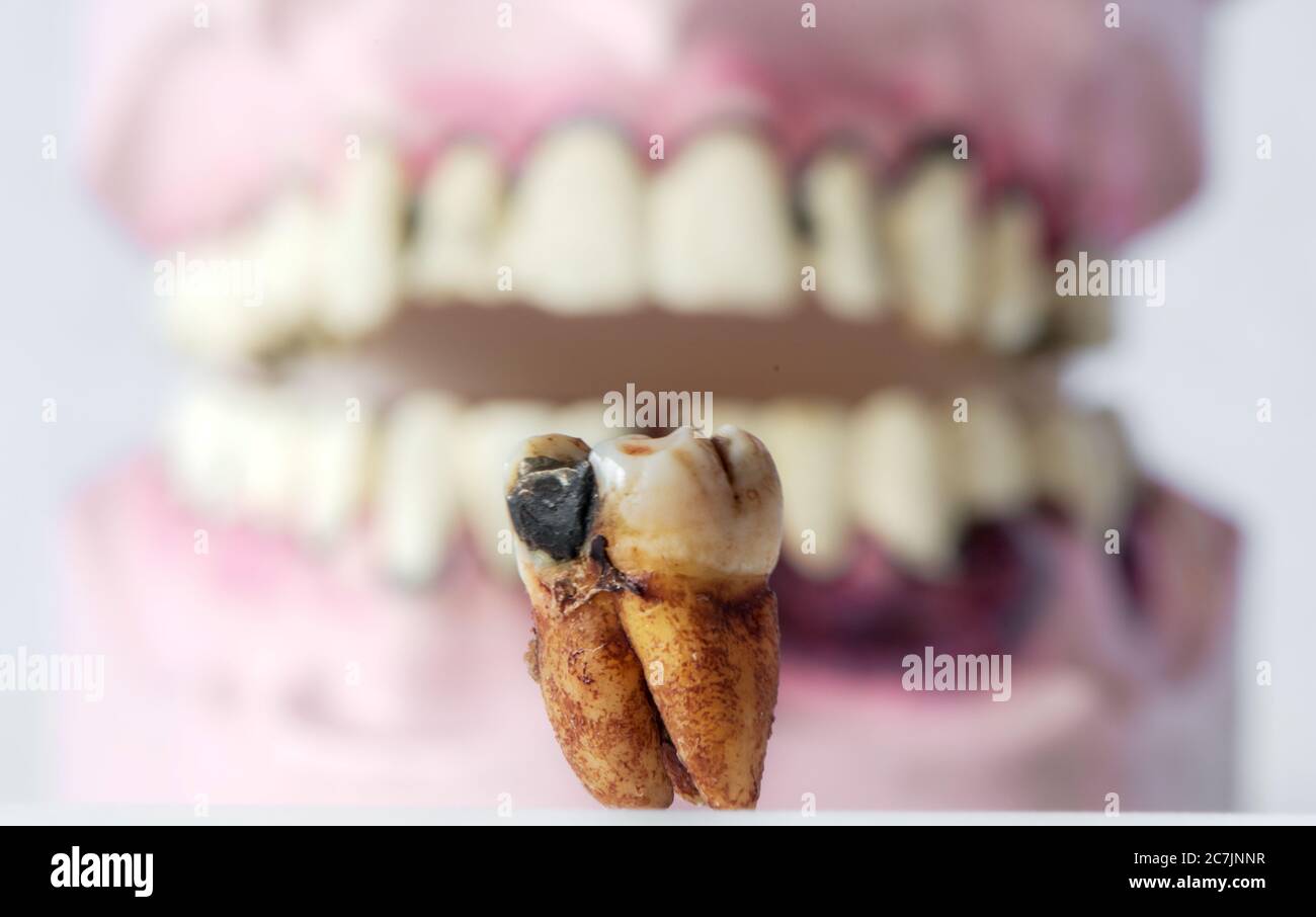 dentiers en bois partiels et dent réelle avec caries et cavités. Soins dentaires. Banque D'Images