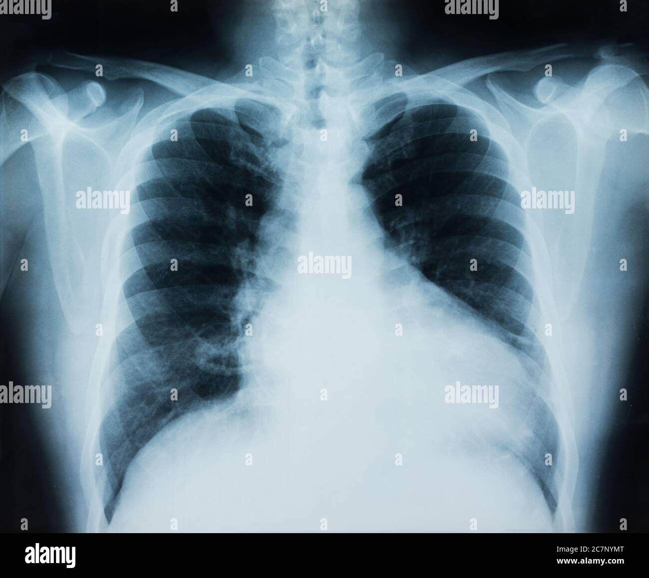 image radiographique du thorax pour diagnostic médical. Banque D'Images
