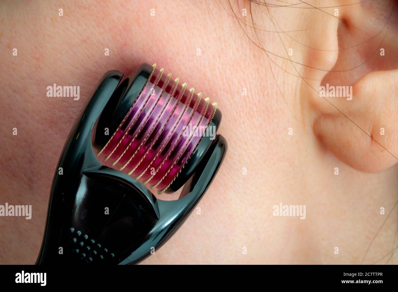Mésothérapie ou microneedle thérapie, prévention des rides et procédures d'acupuncture pour prévenir les rides concept avec rouleau sur le visage de la femme Banque D'Images Mésothérapie ou microneedle thérapie, prévention des rides et procédures d'acupuncture pour prévenir les rides concept avec rouleau sur le visage de la femme Banque D'Images