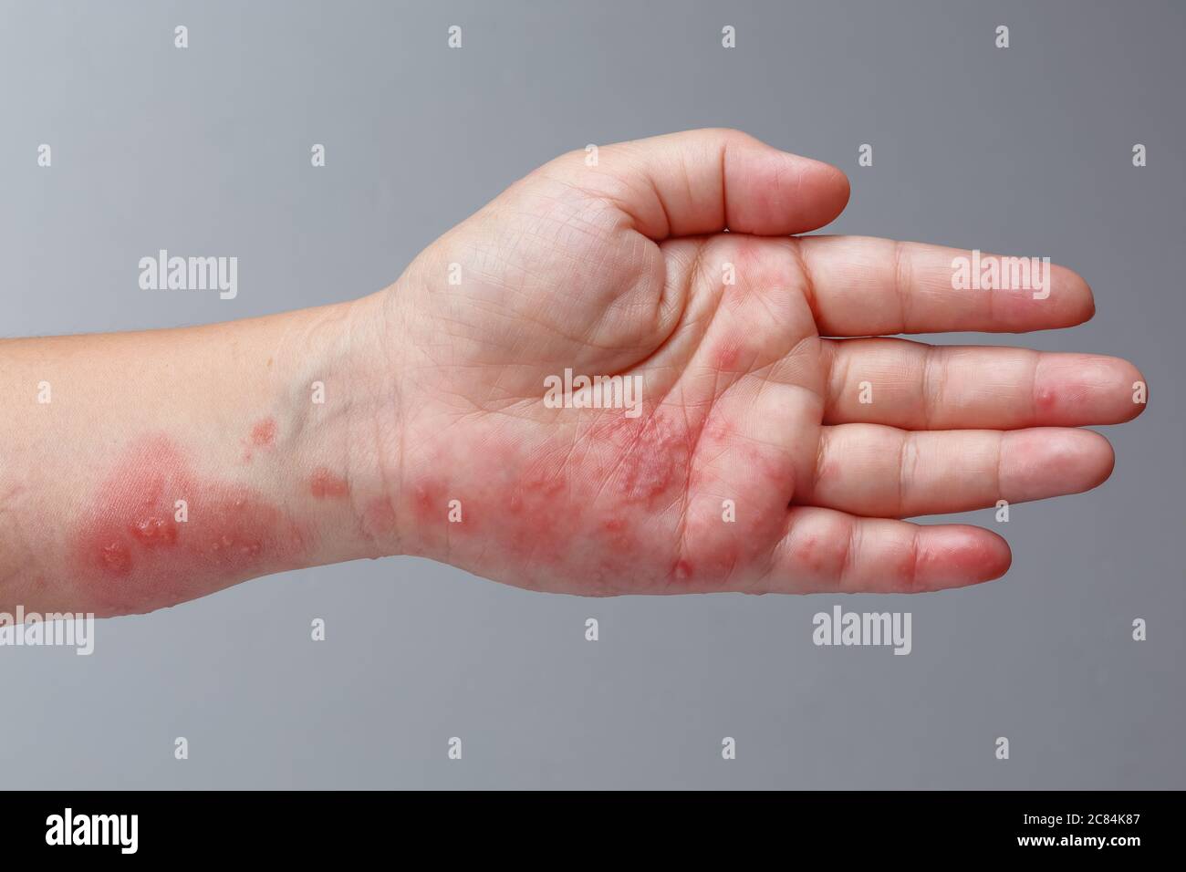 Zona, Zoster ou herpès symptômes de Zoster sur le bras Photo Stock - Alamy