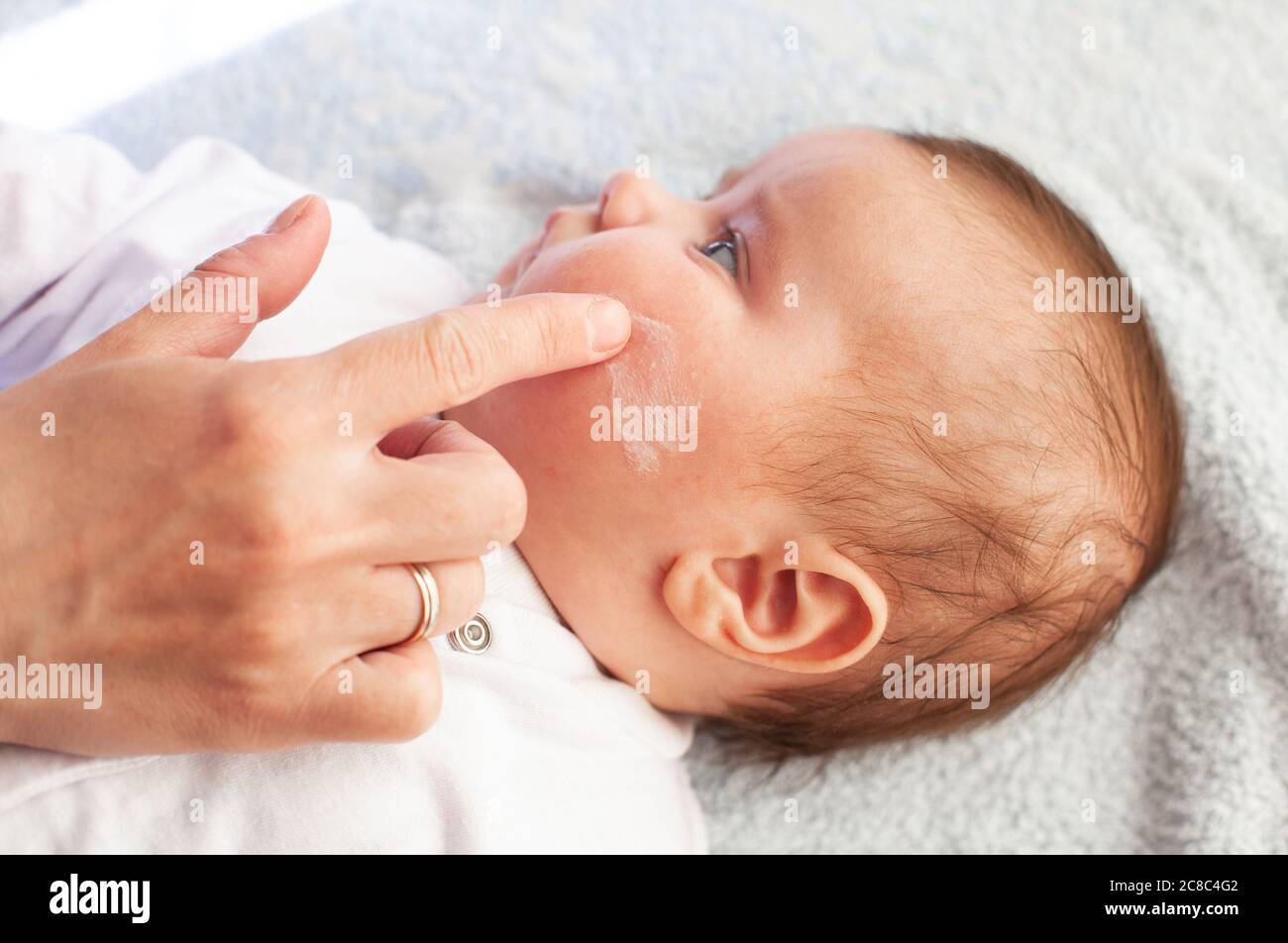 Bebe Avec Dermatite Atopique En Train De Mettre De La Creme Soins Et Prevention De L Eczema Photo Stock Alamy