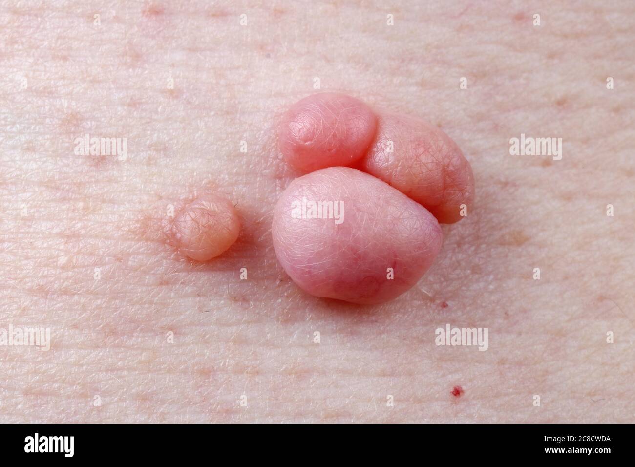 Les verrues, polypes et moles poussent sur la peau humaine toute leur vie macro. Banque D'Images