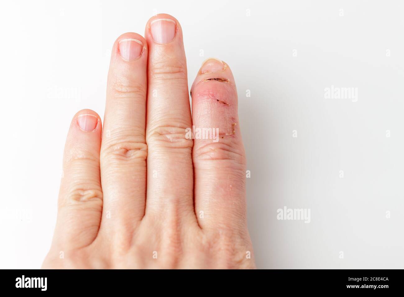 partie de la paume avec l'index coupé avec une blessure de tendon d'extenseur, doigt de maillet, pointe du doigt se pliant vers le bas autres doigts restent droits, déformation dans le dernier os de phalange, mal de chiffre Banque D'Images