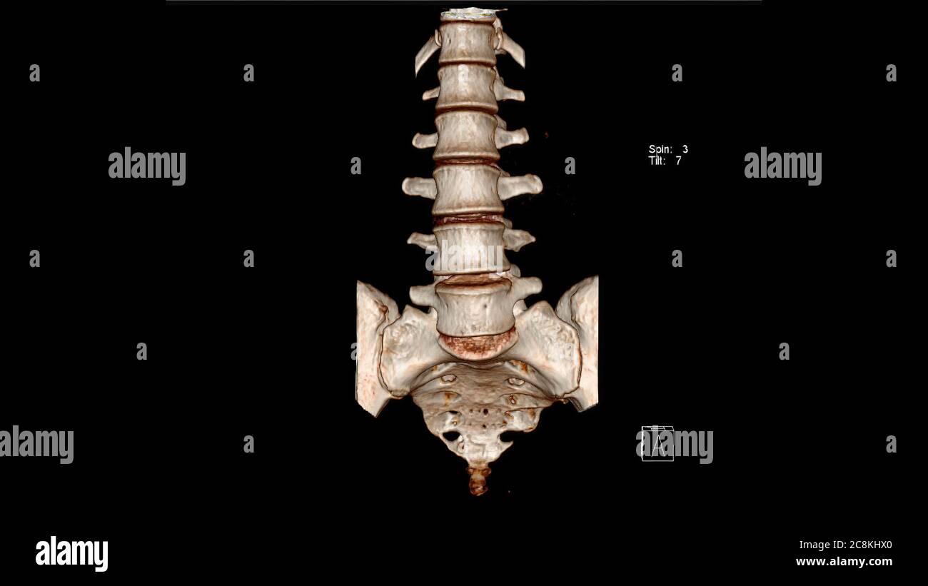 Tomodensitométrie analyse de rendu volumique de la colonne lombaire ( CT VR LSS). Rendu 3D Banque D'Images