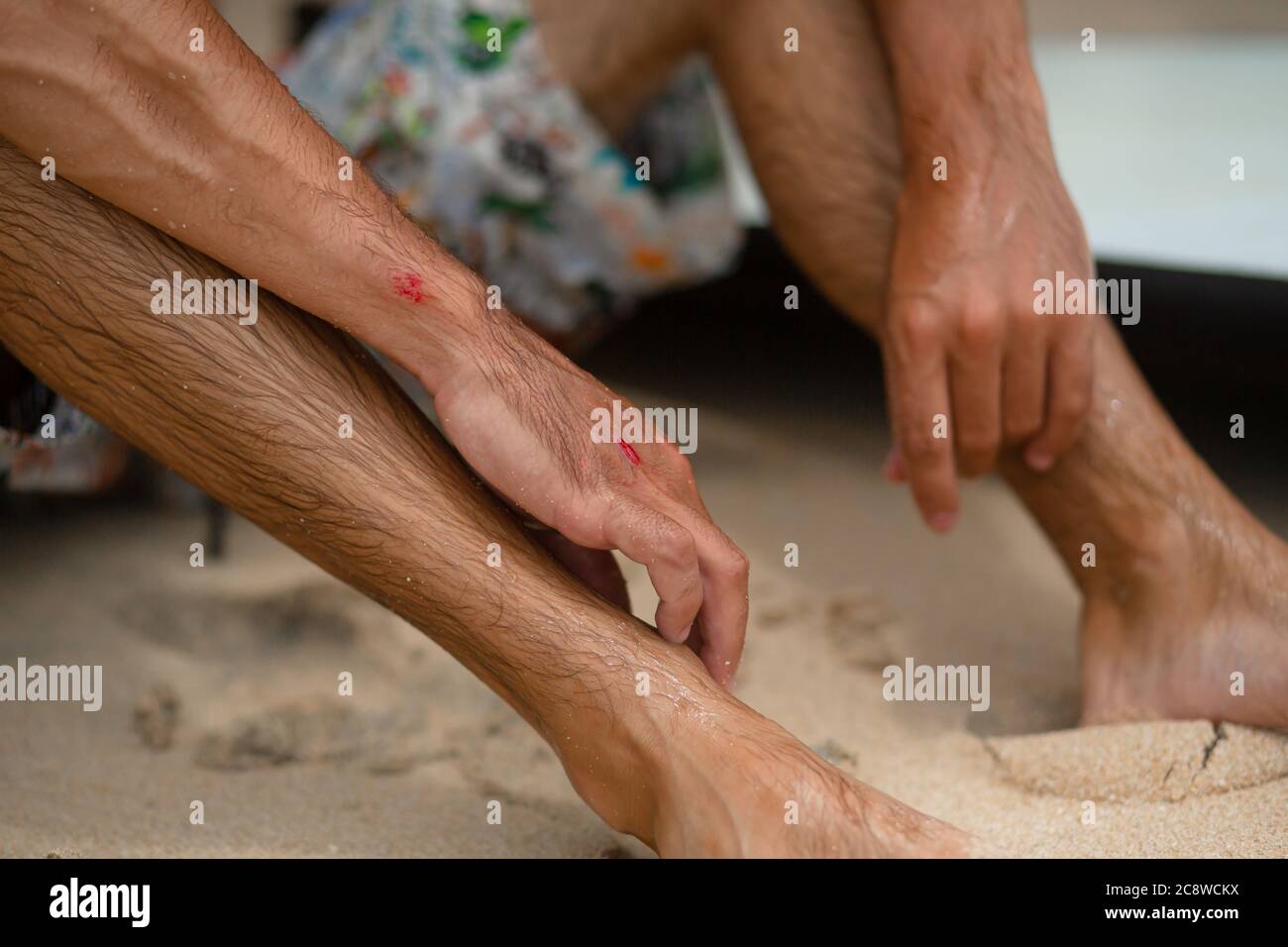 Le gars a eu des abrasions après une chute infructueuse du surf. Un gars mouillé sur la rive examine un bras blessé Banque D'Images