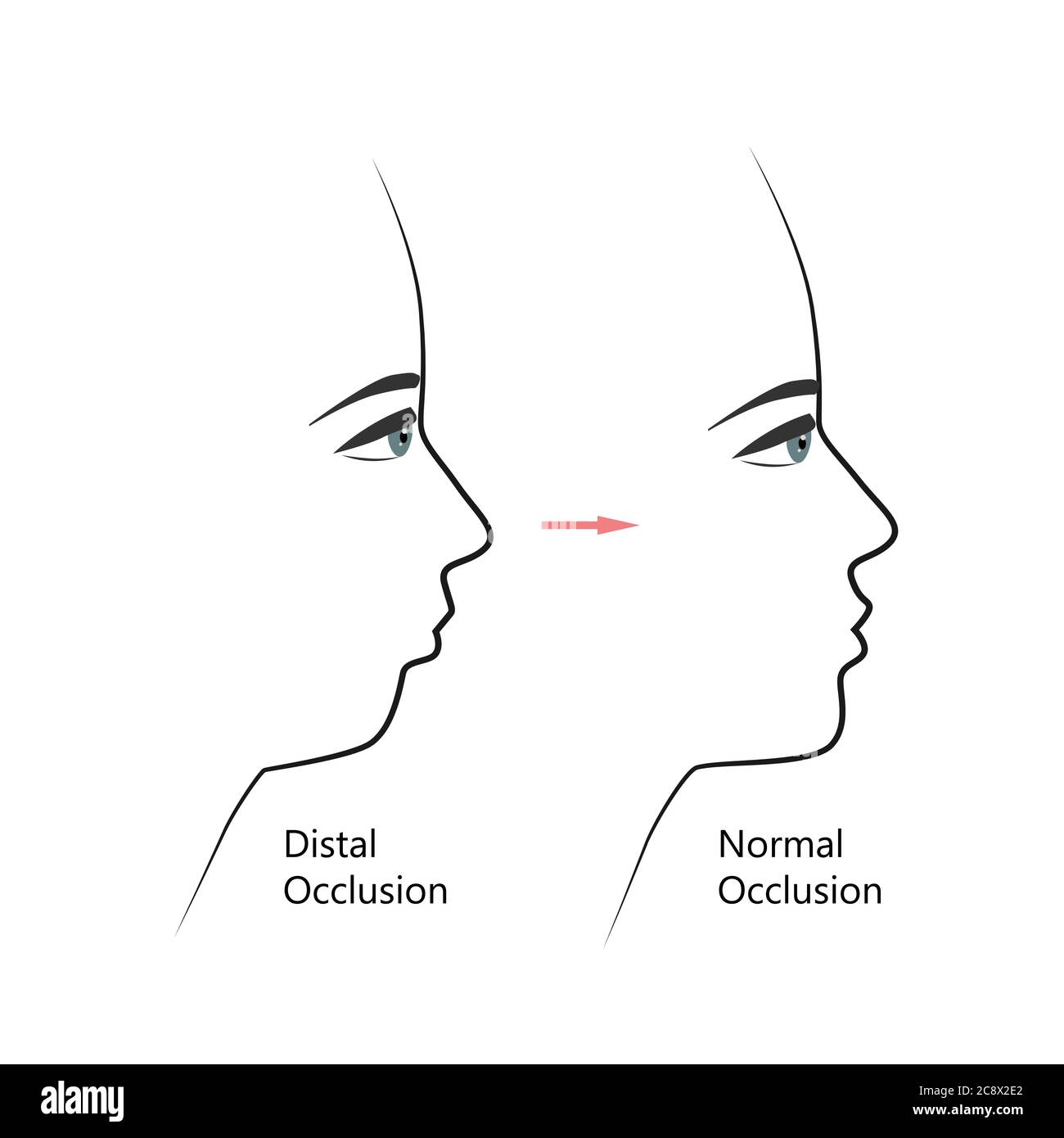 Profil distal de la morsure avant et après un traitement orthodontique. Humain présentant une malocclusion, une mâchoire inférieure repoussant, une correction de morsure par des accolades. Vecteur Illustration de Vecteur
