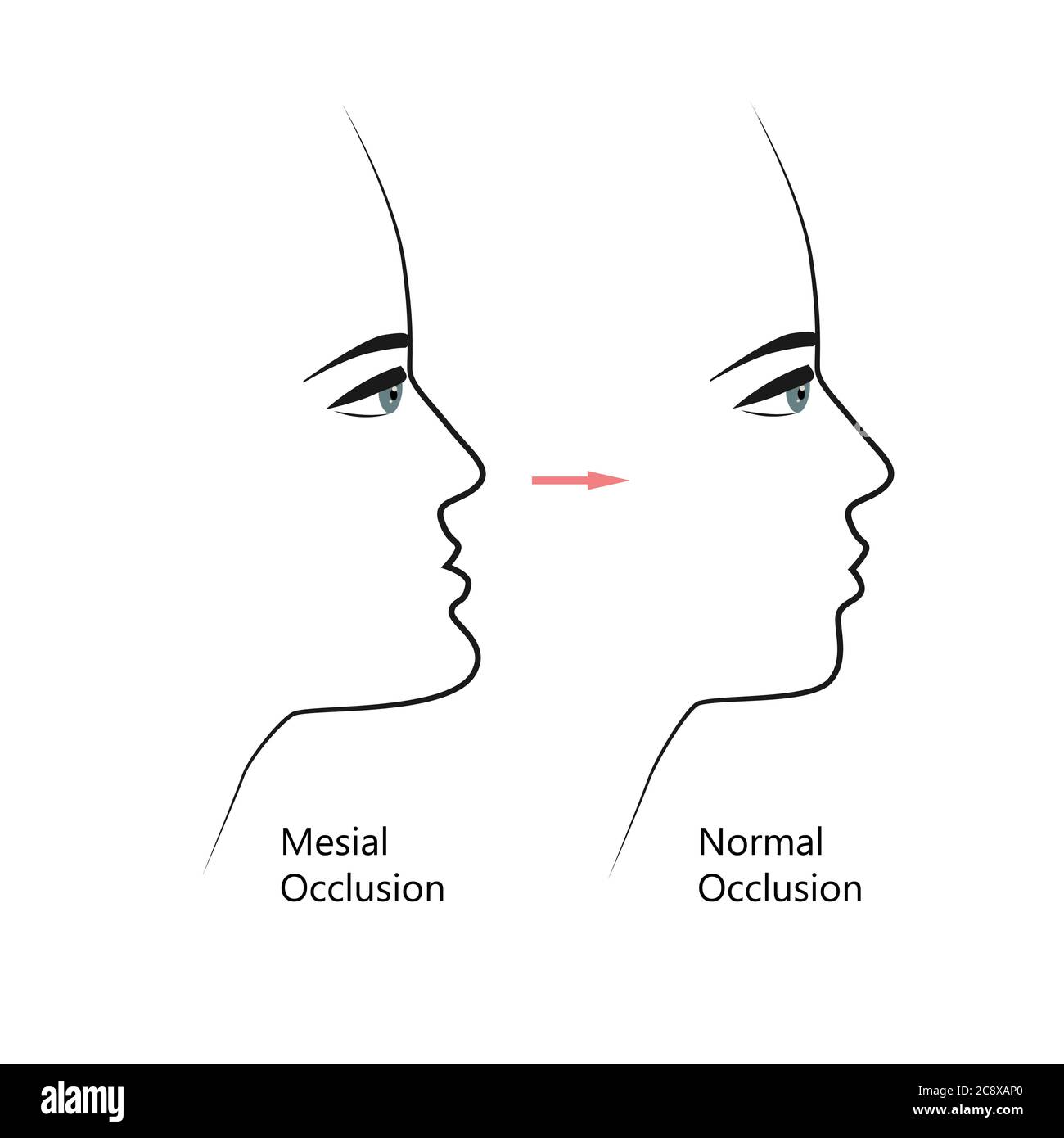 Profil de morsure mésiale avant et après un traitement orthodontique. Humain présentant une malocclusion, mâchoire inférieure étendue vers l'avant, correction des morsures par les accolades. Vecteur Illustration de Vecteur
