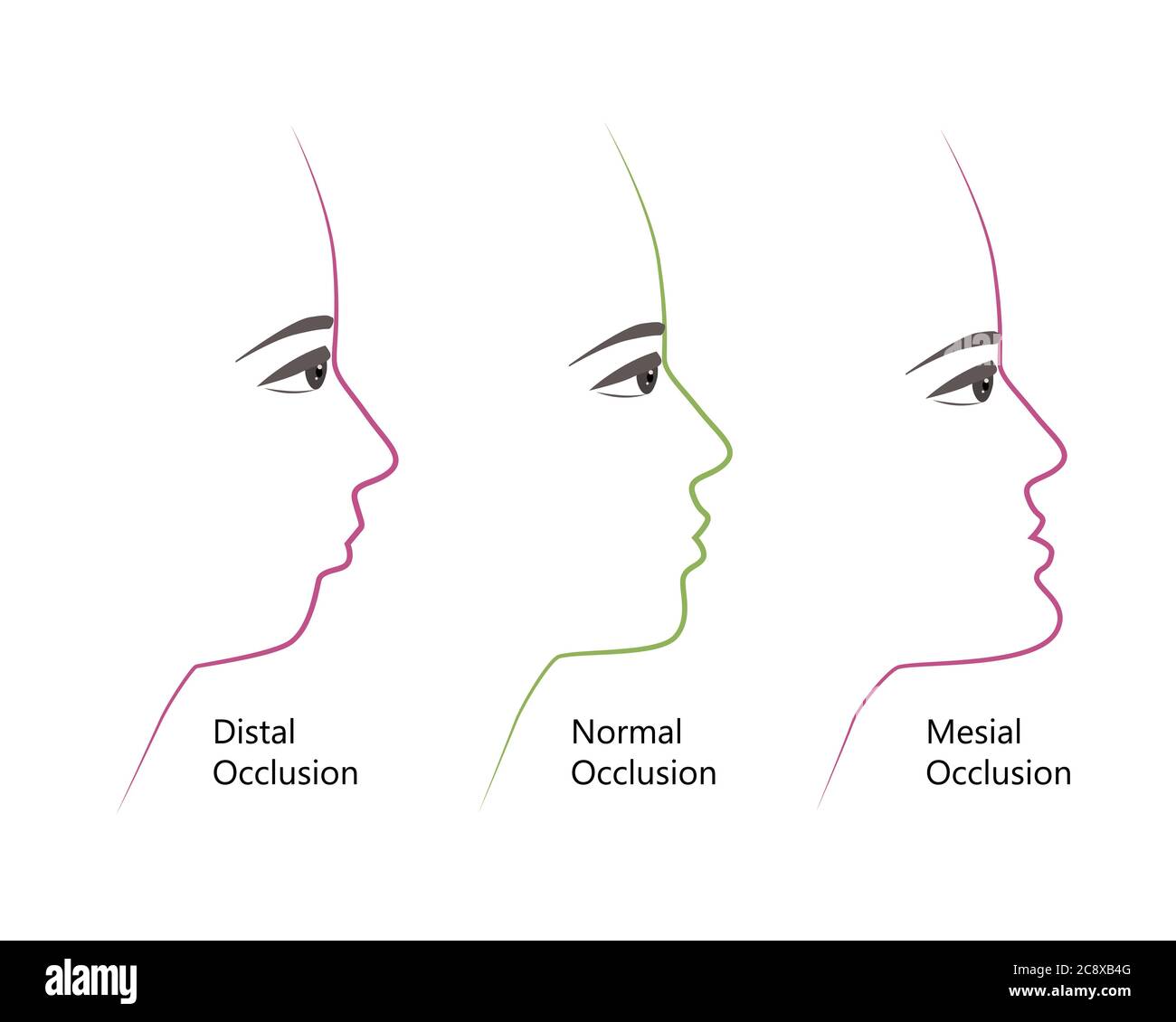 Profil de morsure distal, normal et mésial, illustration vectorielle. Surpiqûres ou sous-morsures avant et après un traitement orthodontique. Humain avec malocclusion Illustration de Vecteur