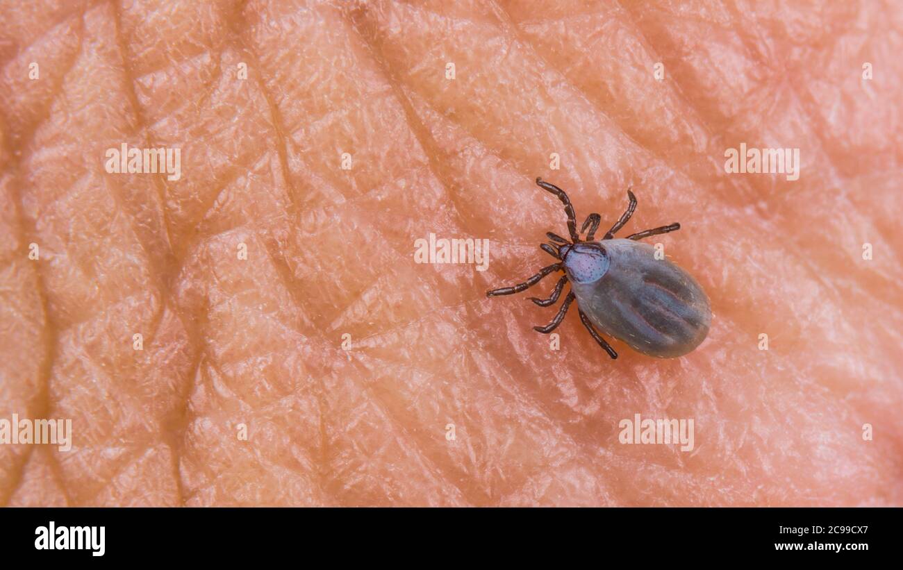 La petite femelle tick sur la texture de la peau humaine. Ixodes ricinus ou scapularis. Acariens parasites. Corps gras plein de sang. Encéphalite, maladie de Lyme. Banque D'Images